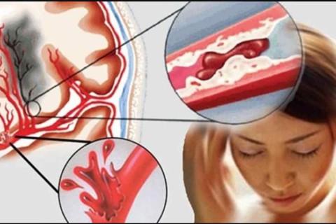 Cảnh Báo: Cái Lạnh Nguy Hiểm Gấp 8-10 Lần Cái Nóng – Nguy Cơ Đột Quỵ Tăng 80% Khi Nhiệt Độ Dưới 15°C