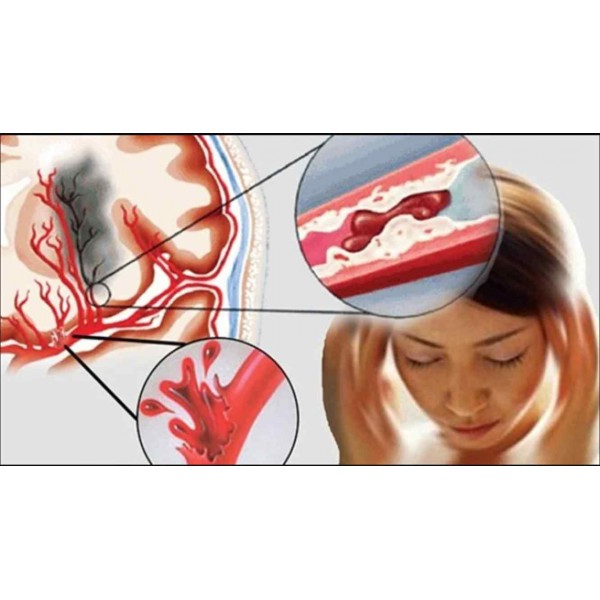 Cảnh Báo: Cái Lạnh Nguy Hiểm Gấp 8-10 Lần Cái Nóng – Nguy Cơ Đột Quỵ Tăng 80% Khi Nhiệt Độ Dưới 15°C