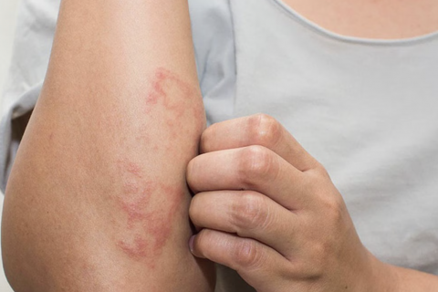 Phòng Ngừa Bệnh Da Liễu Mùa Ẩm Ướt Cho Cả Gia Đình